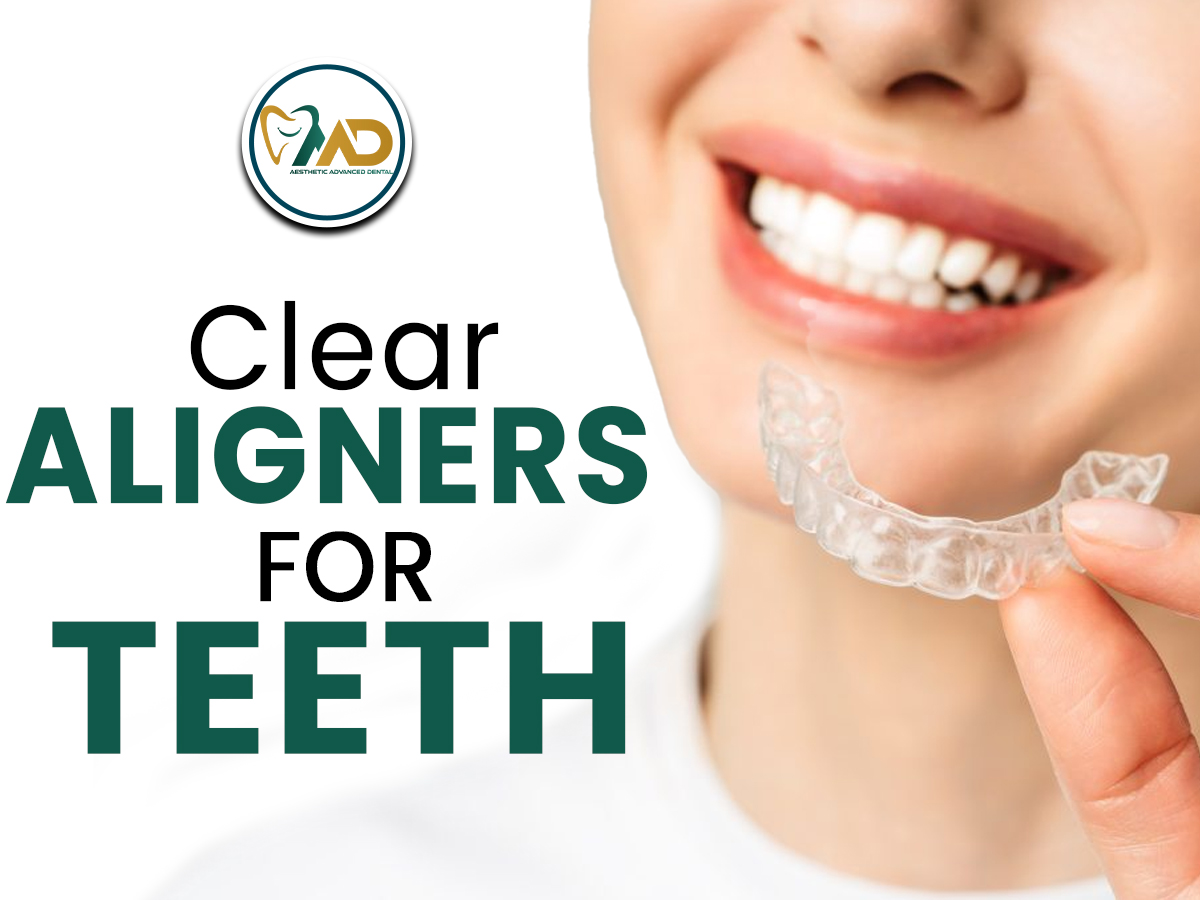 Clear Aligners for Teeth 