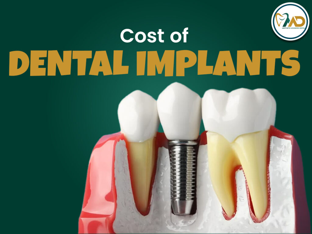 Cost of Dental Implants