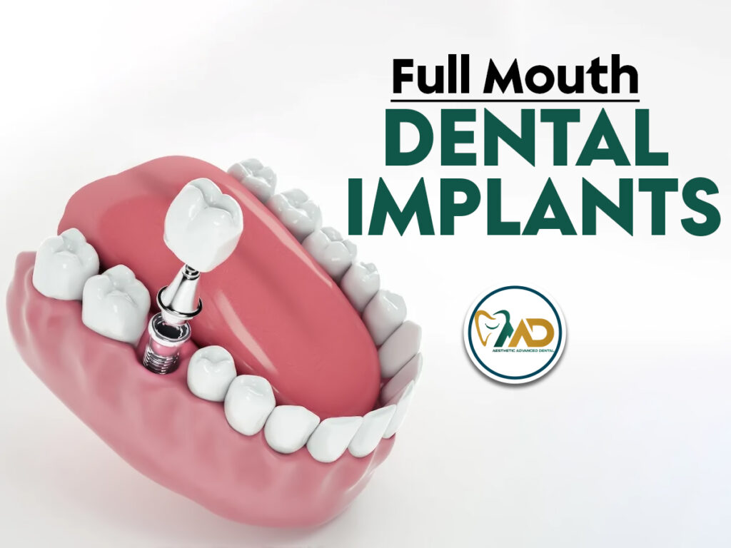 Full mouth dental implants