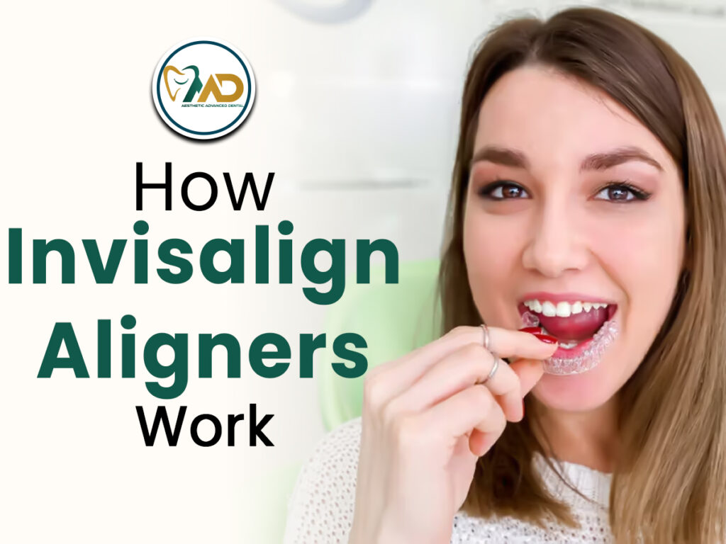 How Invisalign Aligners Work 