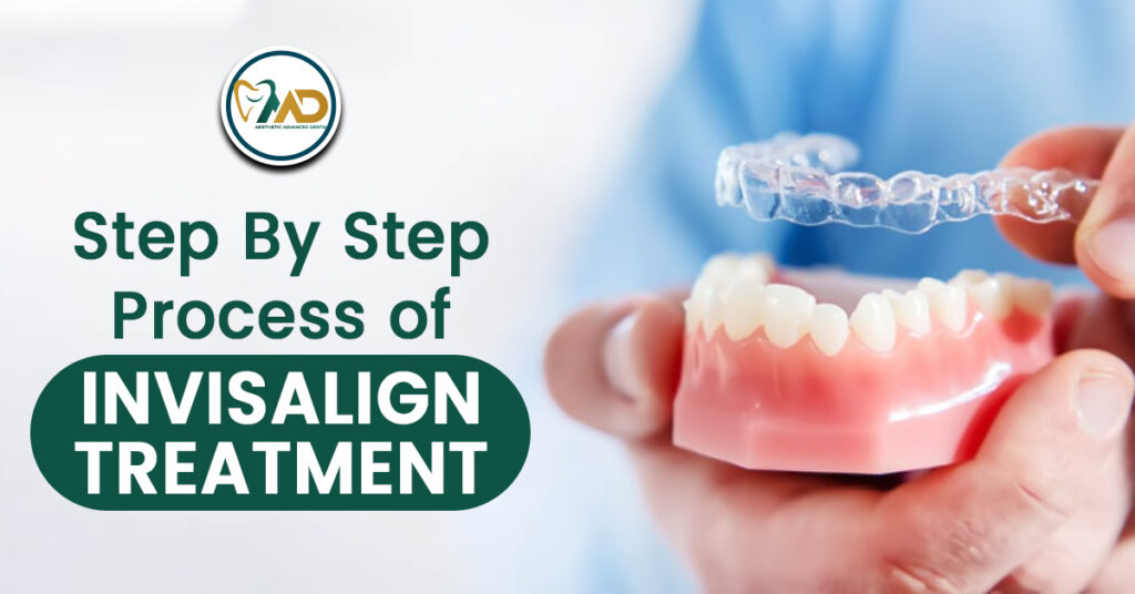 Step-by-Step Process of Invisalign Treatment