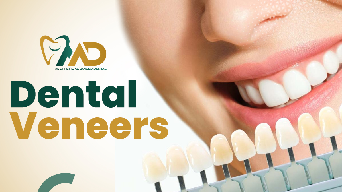 Dental Veneers