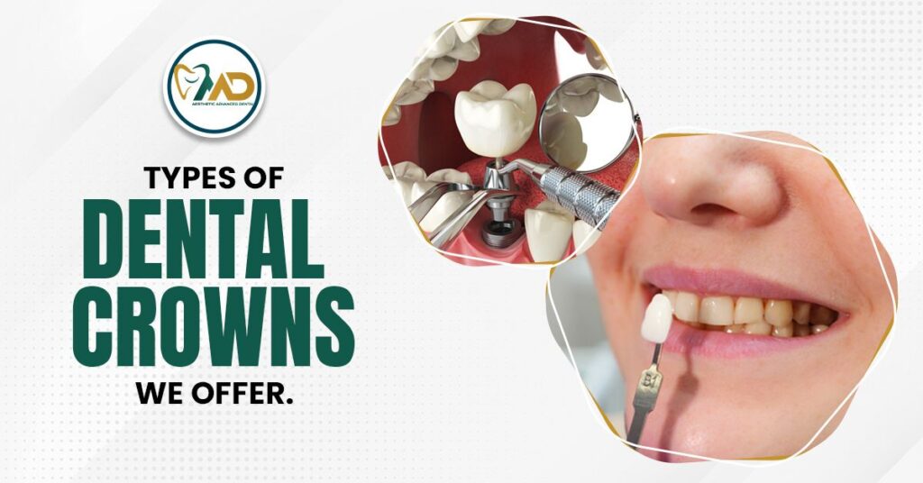 Types of Dental Crowns We Offer