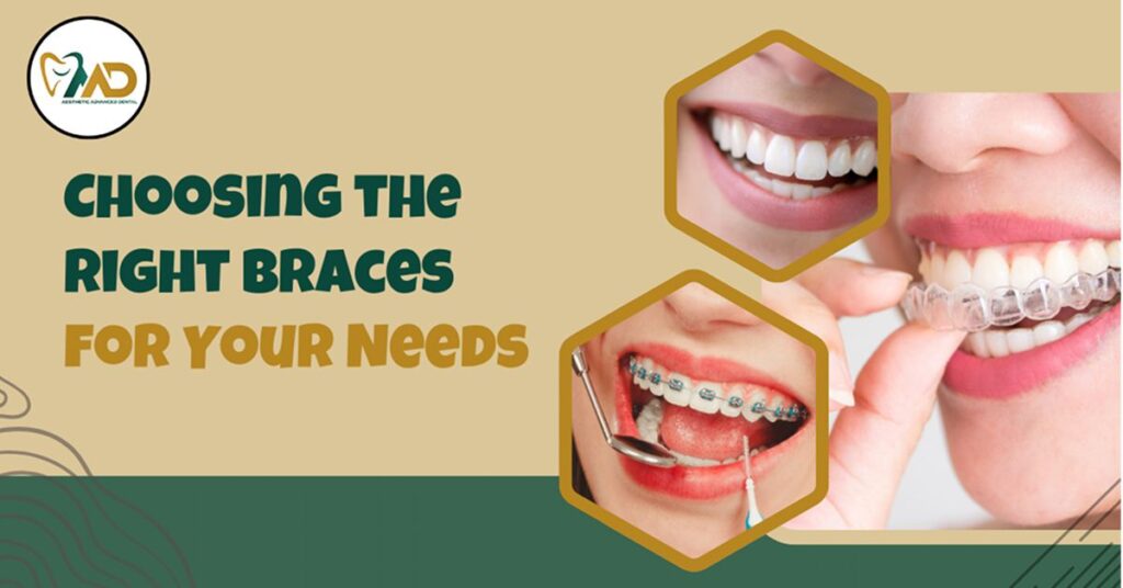 Choosing the Right Braces for Your Needs