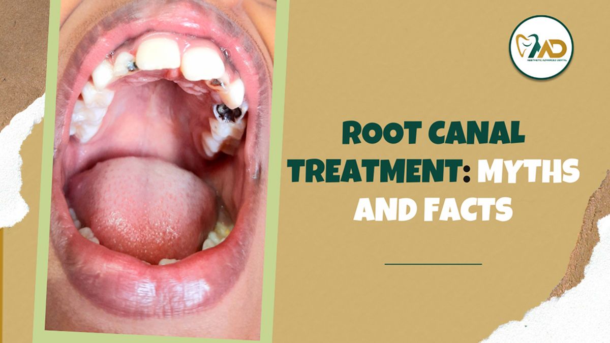 Root Canal Treatment Myths and Facts