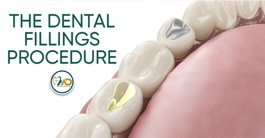 Dental Filling Procedure