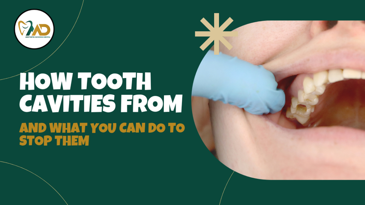 How Tooth Cavities Form and What You Can Do to Stop Them