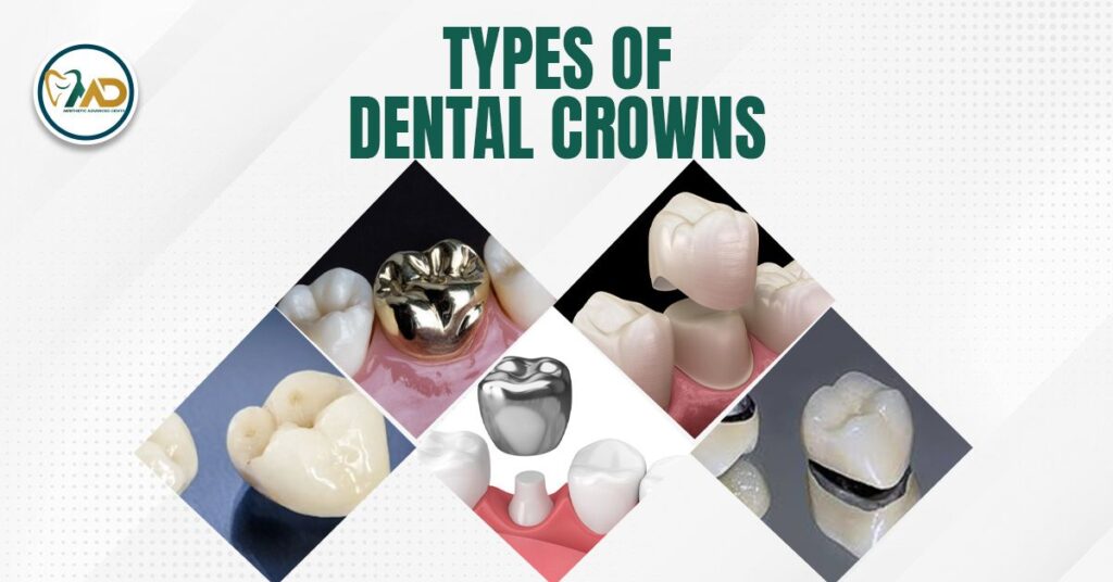 Types of Dental Crowns