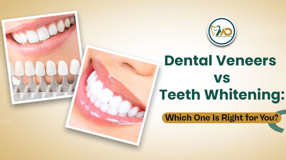 Dental Veneers vs Teeth Whitening