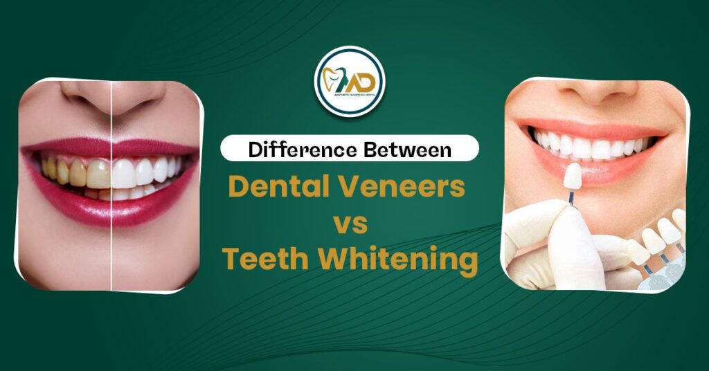 Differences Between Dental Veneers vs Teeth Whitening